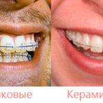 Types of braces