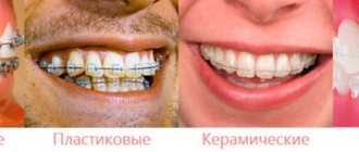 Types of braces