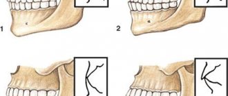 Types of human bite