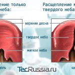 types of cleft palate