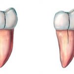 types of cracks in teeth