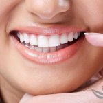 Veneers for teeth