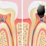 Internal caries