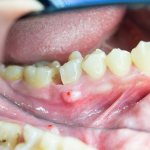 inflammation of the periosteum of the tooth