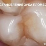Восстановление зуба пломбой. Реставрация зуба