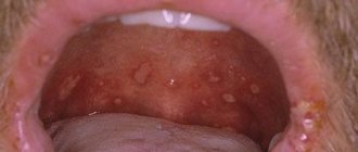 Throat ulcer