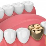 Gold teeth pros and cons