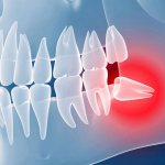 wisdom tooth growing incorrectly