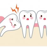 Wisdom tooth