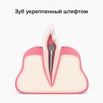 Зуб укрепленный штифтом в картинках