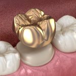 Dental crown