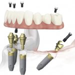 dental implants