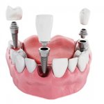 Зубные коронки - Стоматология Линия Улыбки