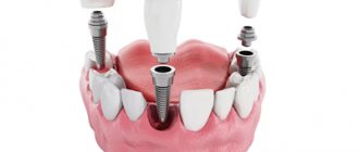 Dental crowns - Dentistry Line Smiles